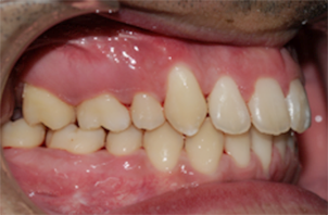 implantes dentales